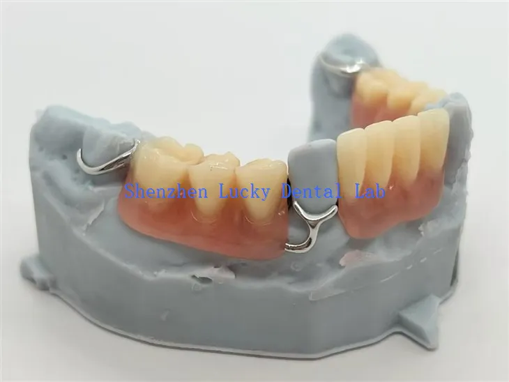 Partiels en acrylique imprimés en 3D avec fermoir à barre en T