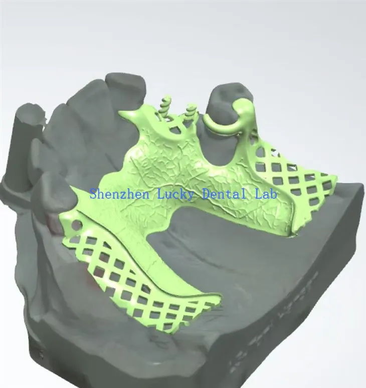 Fabricants de cadre en métal dentaire à imprimé 3D