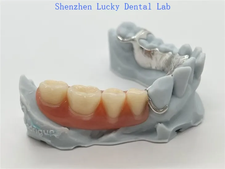 Cadre en métal Co Cr imprimé en 3D avec prothèses dentaires en acrylique