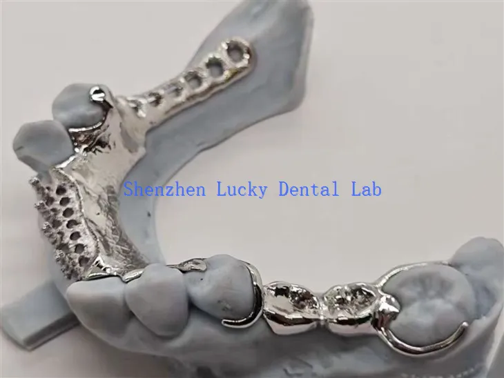 Cadre métallique à imprimé 3D avec conception de dents soutenues en alliage