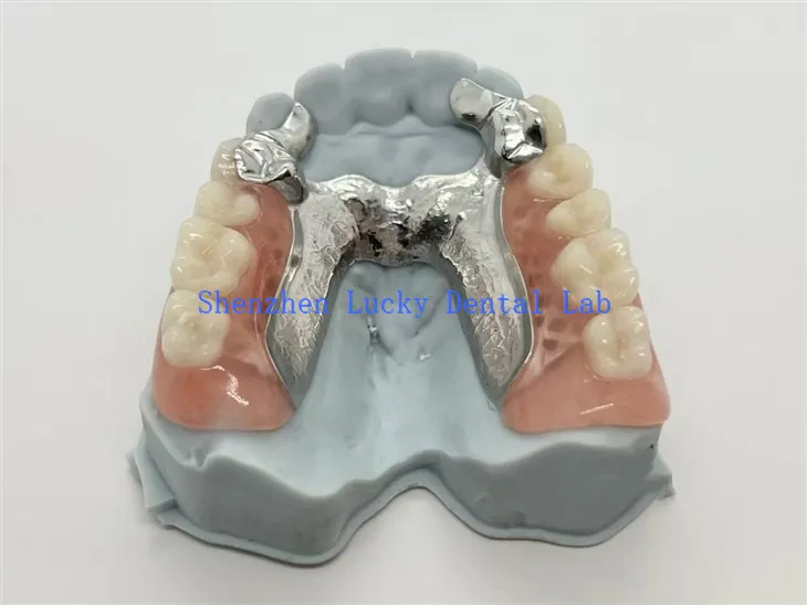 Prothèse partielle en métal imprimée en 3D avec support de dent en alliage