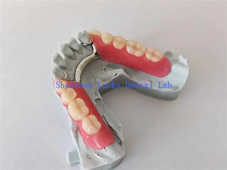 Impression 3D Pratisation en acrylique partielle avec cadre métallique Essayez dans le laboratoire dentaire