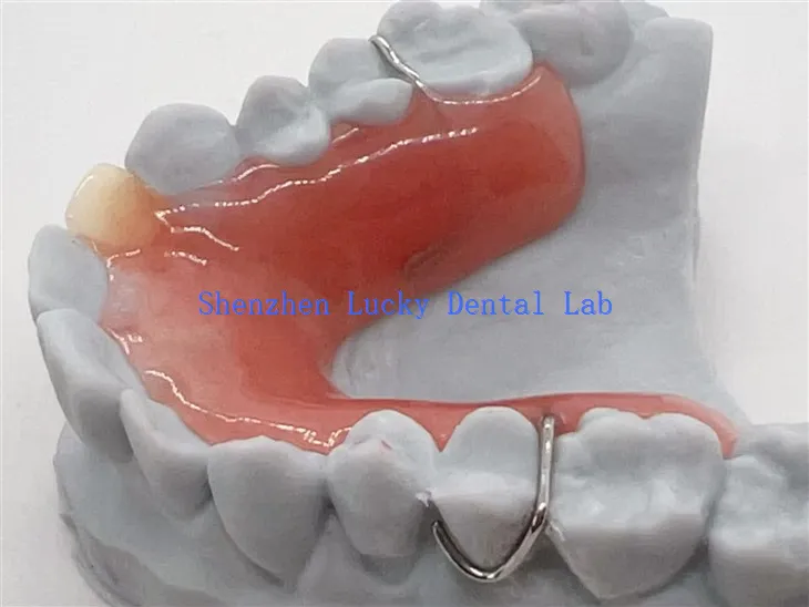 Prothèse partielle amovible imprimée en 3D avec base en acrylique