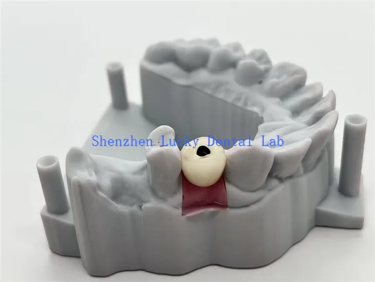 Vis d'impression 3D-Cobalt retenu-Couronne d'implant dentaire en porcelaine chromée