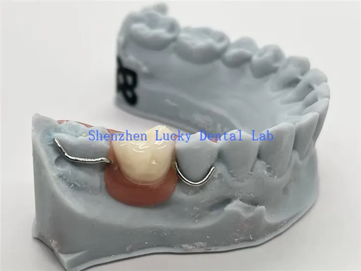 Prothèse acrylique unilatérale imprimée en 3D