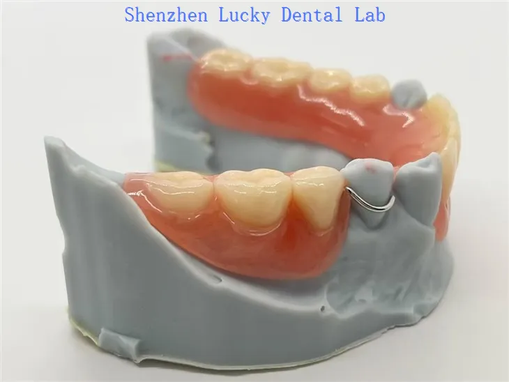 Prothèse partielle amovible en acrylique avec fermoir à fil