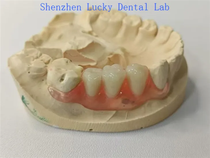 Flipper dentaire dentaire esthétique