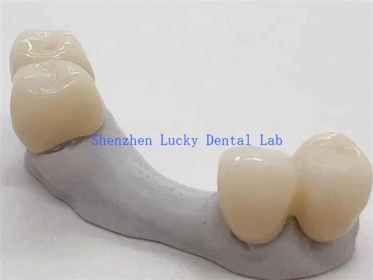 Bridge dentaire esthétique en zircone