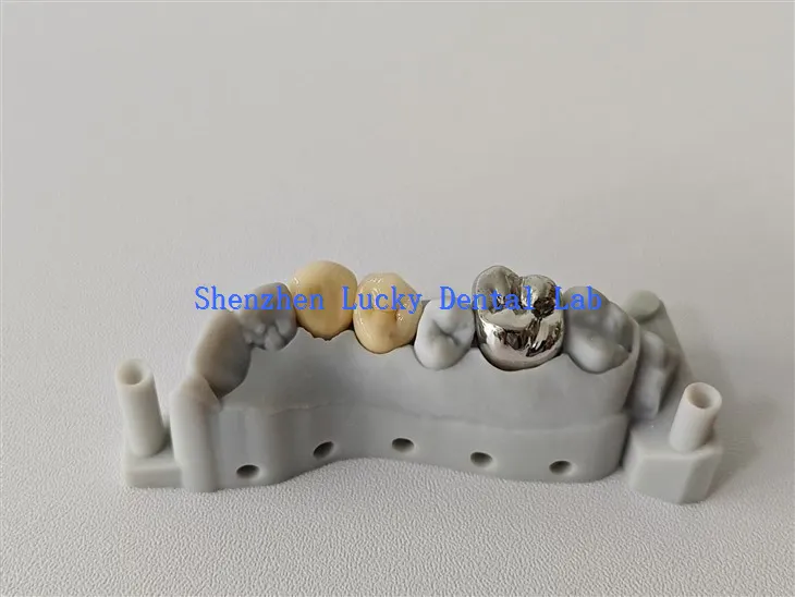 Esthétique Print 3D FMC et couronne PFM Cocr fabriquée en Chine