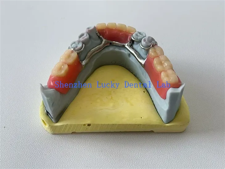 Cadre de dentaire à imprimé 3D abordable avec fabricants de barres linguaux