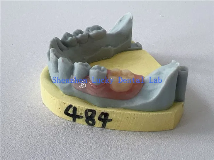 Chine 3D Imprimer dentaire partiel flexible Flexible Factory