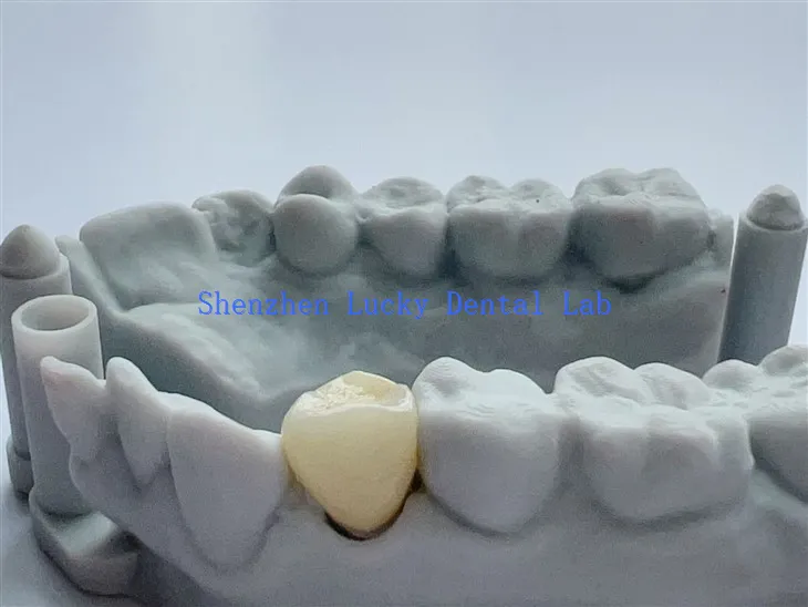 Chine esthétique dentaire complet Contour de zircone