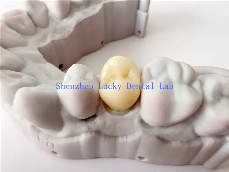 Chine Couronne de zircone dentaire à imprimé 3D personnalisé