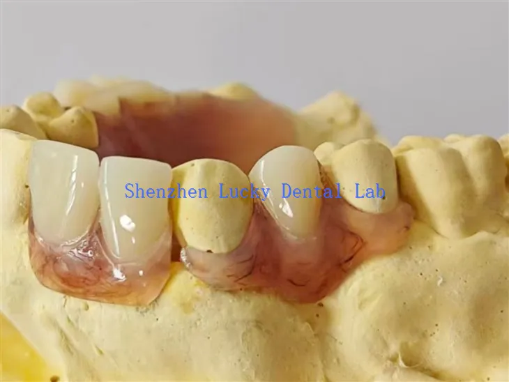 Chine Dark Gum Dental Partial Flexible Denture