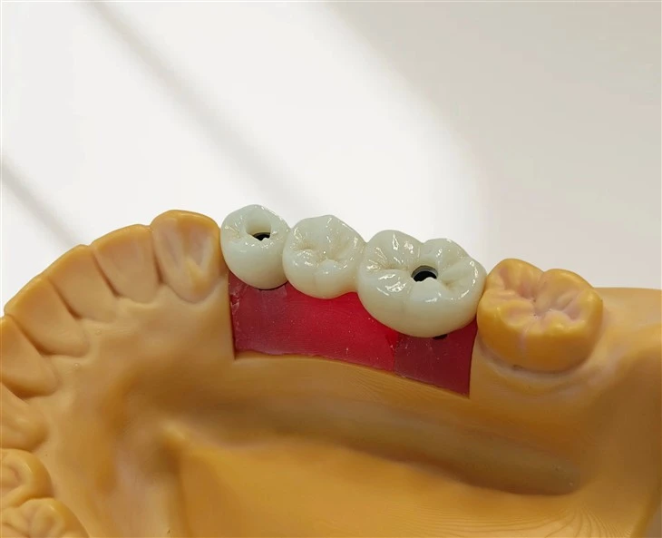 Custom Implant Abutment