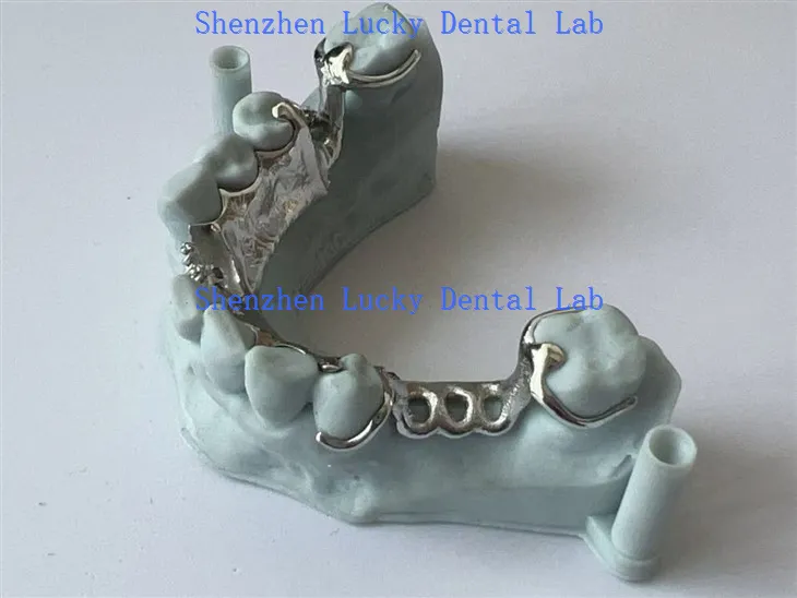 Frame-métal imprimé 3D avec laboratoire dentaire à plaque linguale