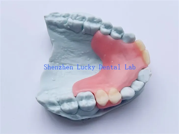 Essai de prothèse flexible partielle dentaire personnalisée chez les fabricants