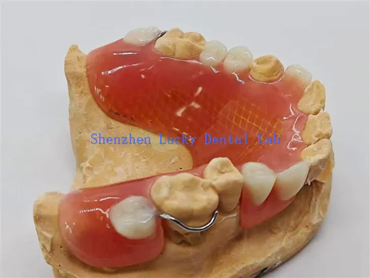 Prothèse partielle amovible avec maille métallique