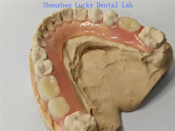 Denture flexible partielle dentaire fabriquée en Chine