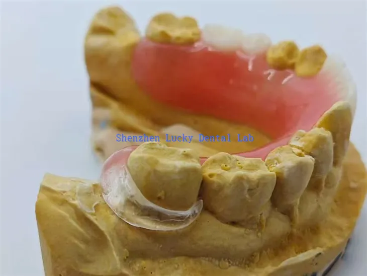 Prothèse acrylique avec fermoir clair