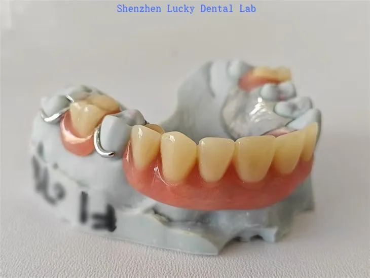 Prothèse acrylique partielle avec armature métallique à fermoir métallique