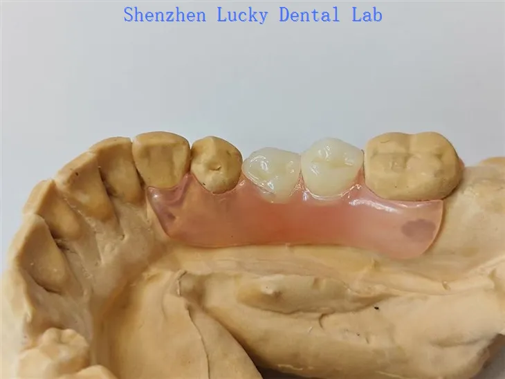 Prothèse dentaire flexible partielle avec des fabricants de fermoirs valplast