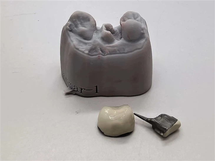 Couronne PFM avec noyau de poteau