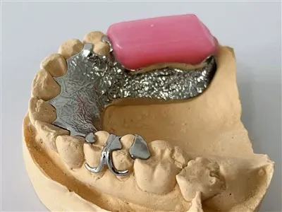 Cadre métallique avec jante de cire et plaque dentaire lingual plaque dentaire