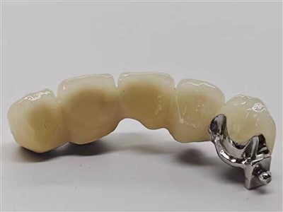 Pont dentaire PFM avec usine de fixation de balle de précision