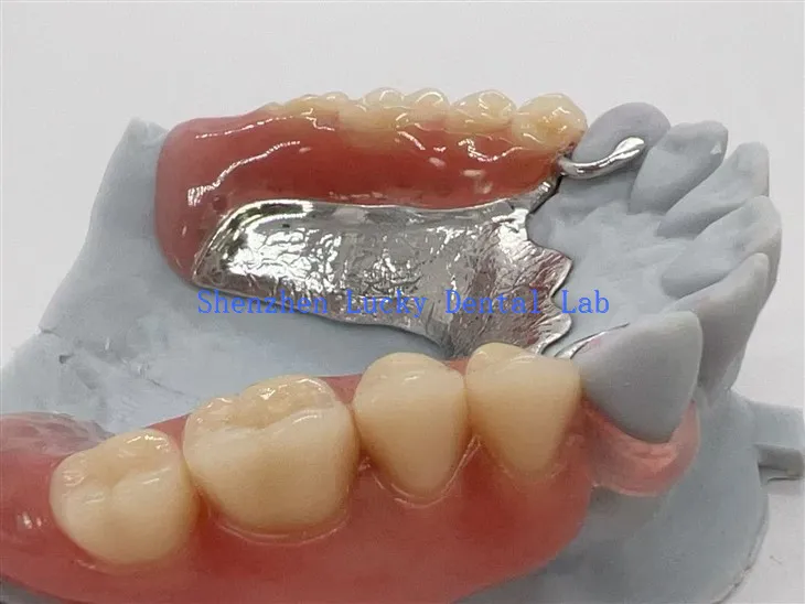 Cadre métallique de fermoir Valplast avec prothèse acrylique