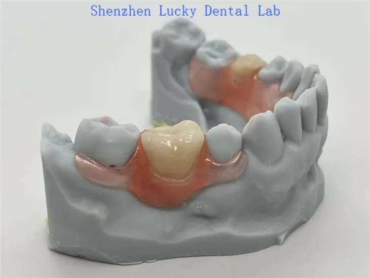 Partials Valplast® avec fermoir flexible