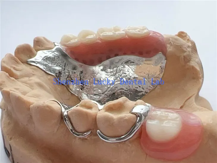 Cadre de métal dentaire en fermoir avec des fabricants de prothèses en acrylique partielles